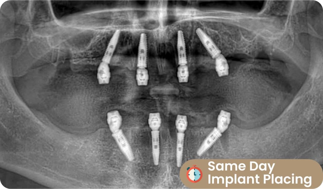 all on four implant placing