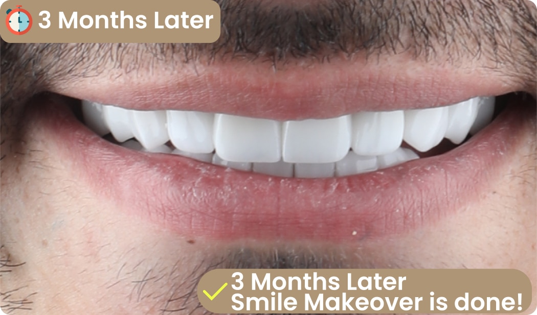 all on six smile makeover