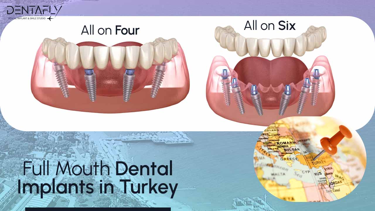 Full mouth dental implants in Turkey