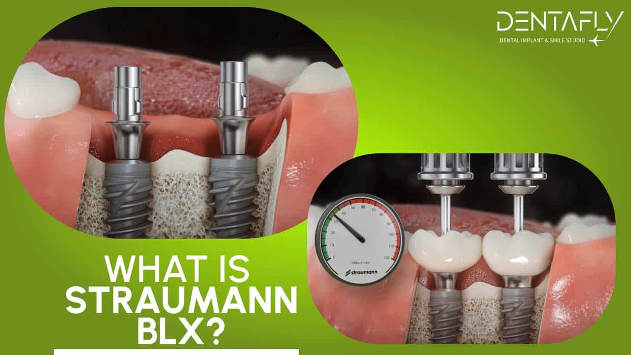Straumann BLX dental implant