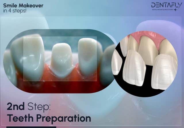 2nd Step Teeth Preparation