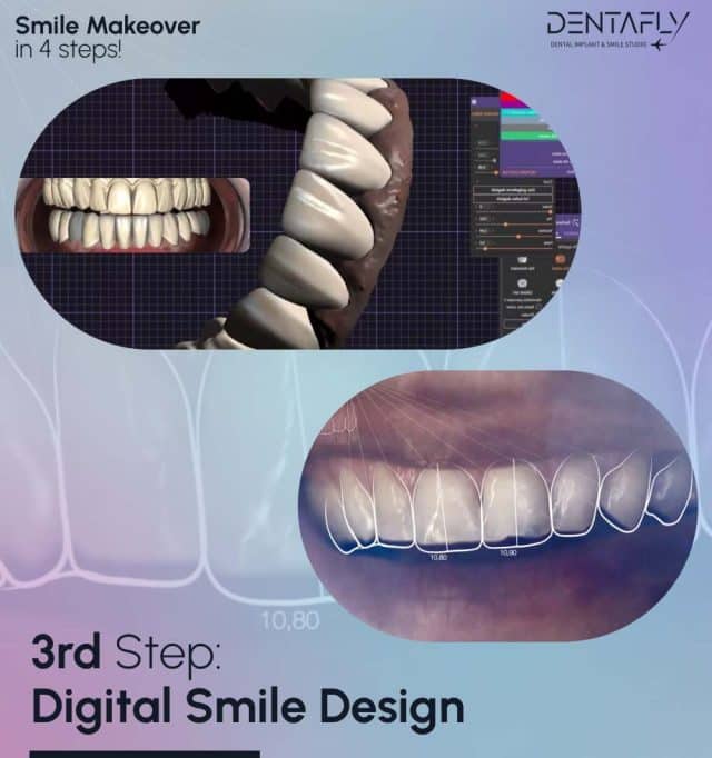 3rd Step: Digital Smile Design in smile makeover