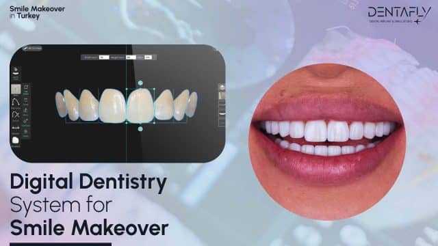 digital dentistry Turkey in Smile Makeover