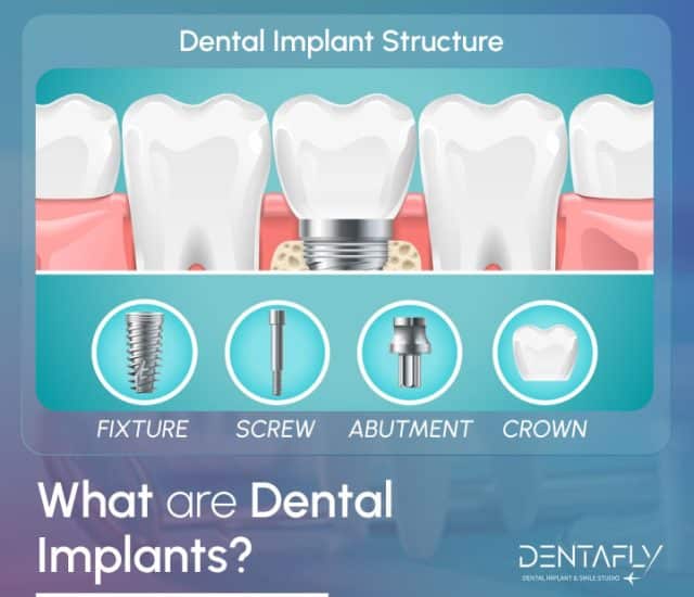 dental implant types and view of material