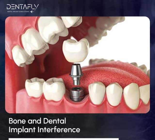 bone interface in dental implants