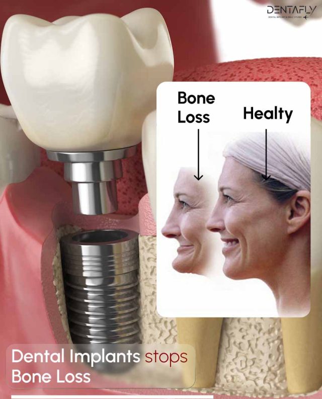 bone loss without dental implant solution