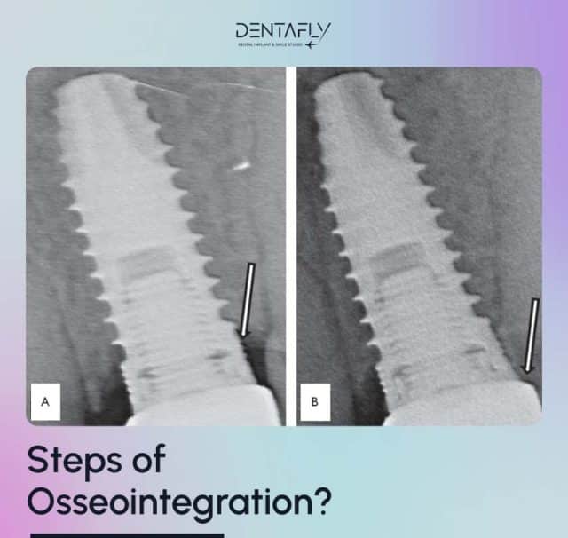 Steps of osseointegration