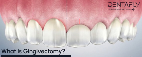 definition gingivectomy