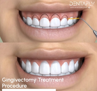 gingivectomy treatment procedure