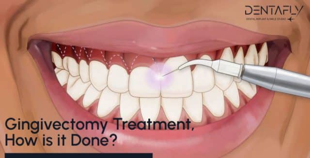 gingivectomy treatment