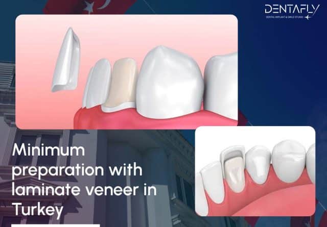 laminate veneer preparation in dental treatment