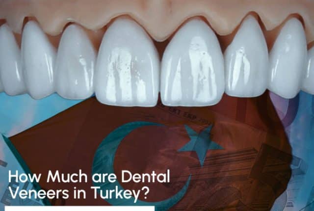 dental veneers in Turkey