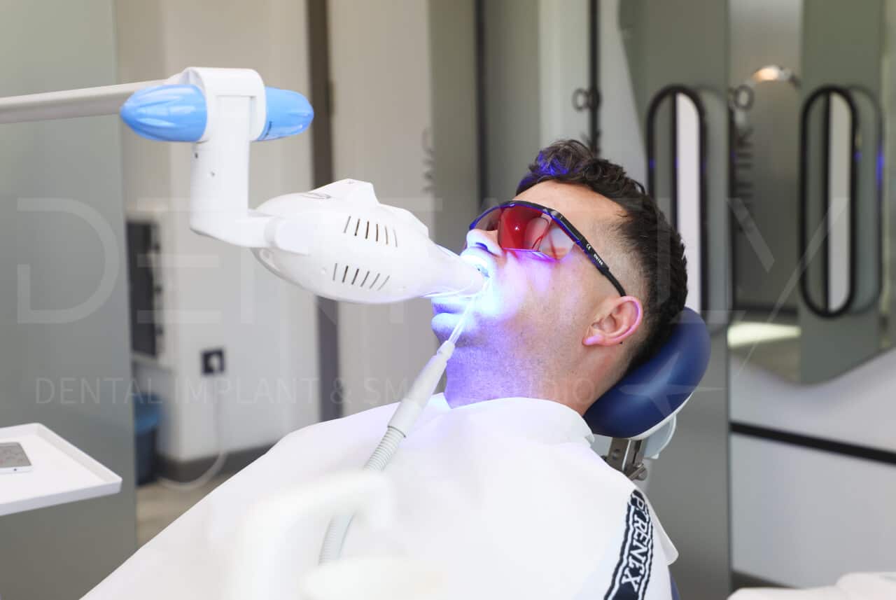 Teeth Whitening Antalya Denta Fly