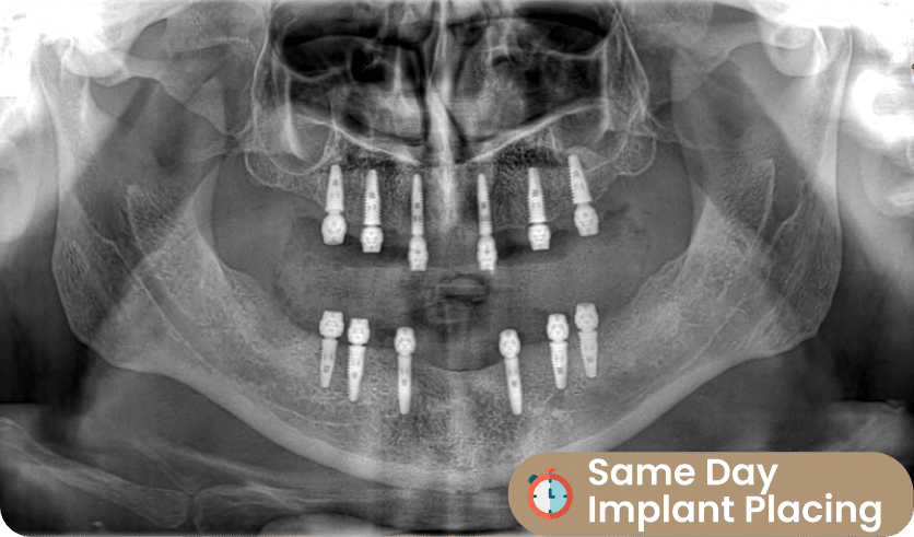 all on six implant placing same day