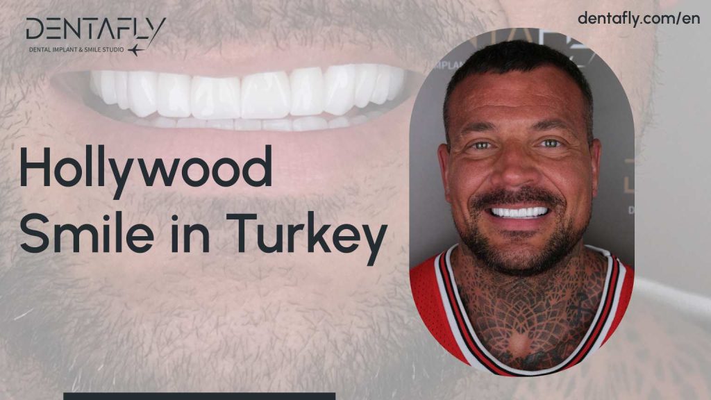 Hollywood Smile in Turkey