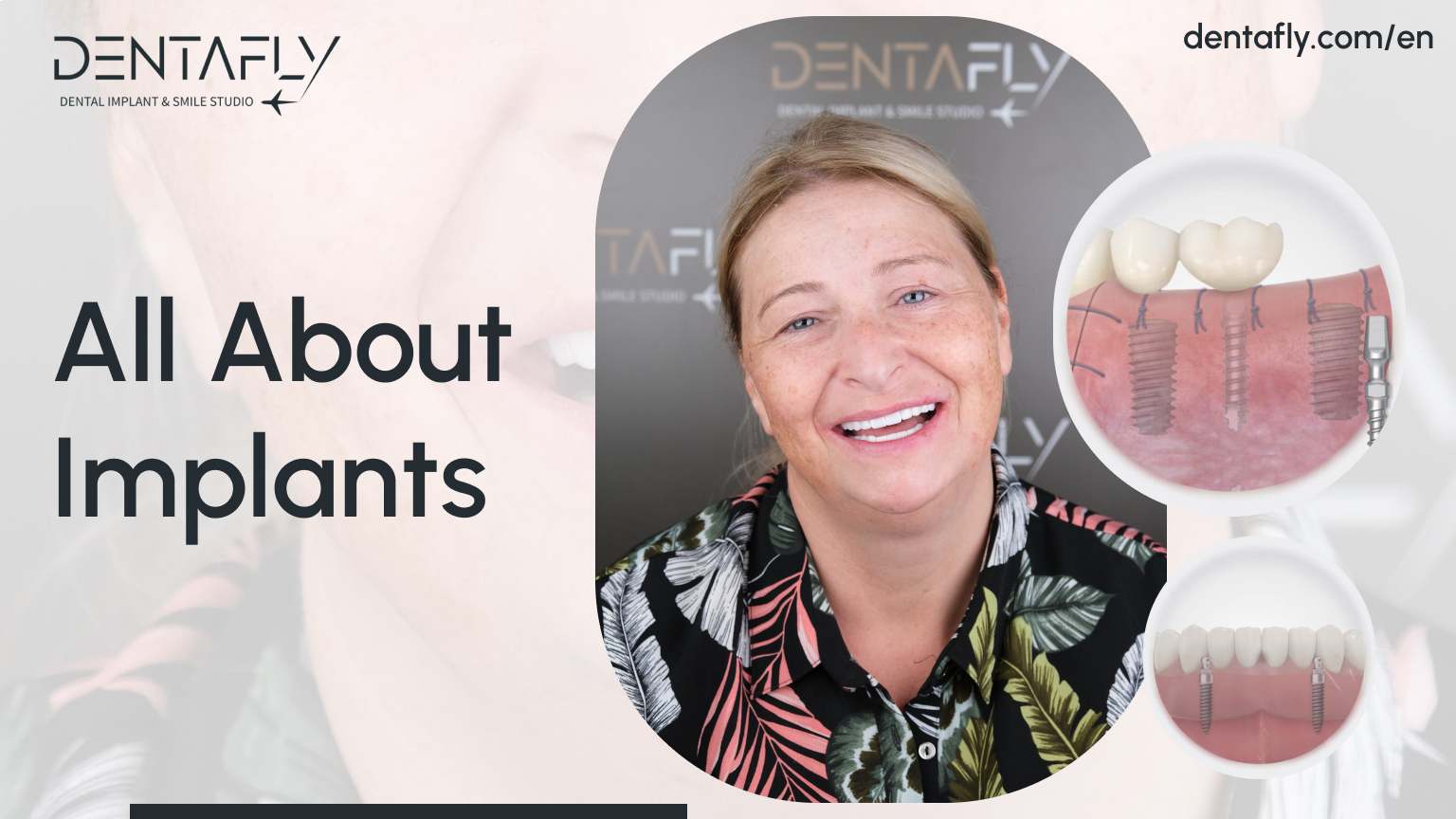 all about implants