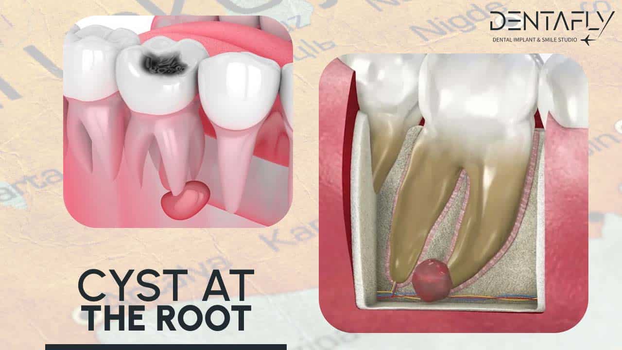 cyst of the tooth root in gum treatment