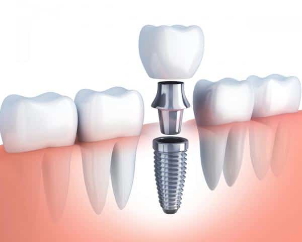 dental implants in Antalya Turkey