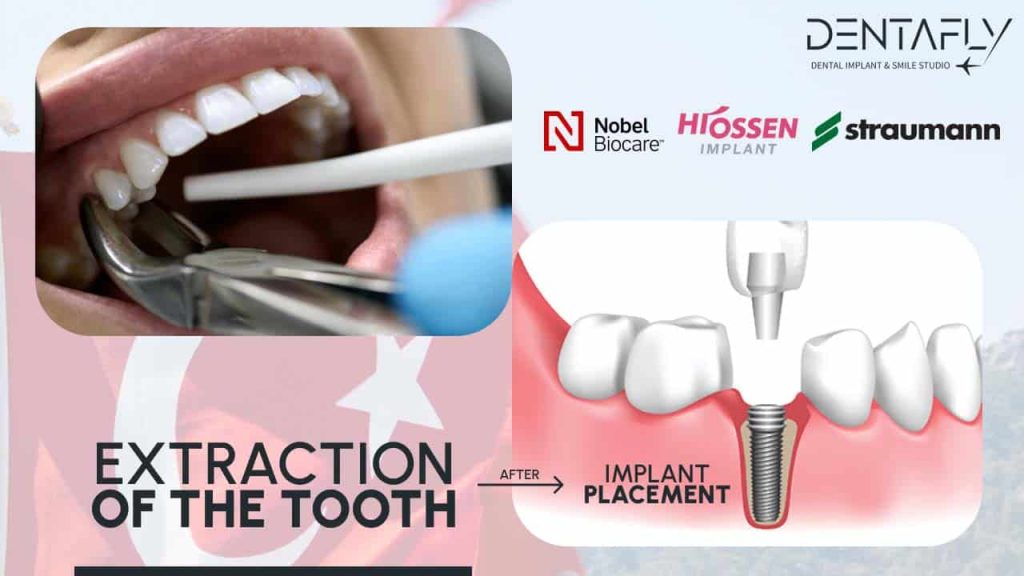 The Process of Wisdom Teeth Extraction: An Overview with Dentists