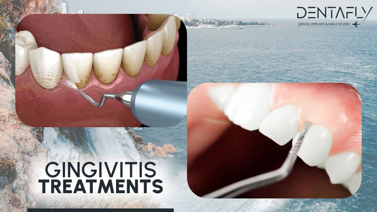 Gingivitis treatment in Turkey
