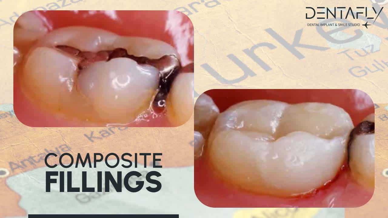 gum treatment after composite filling