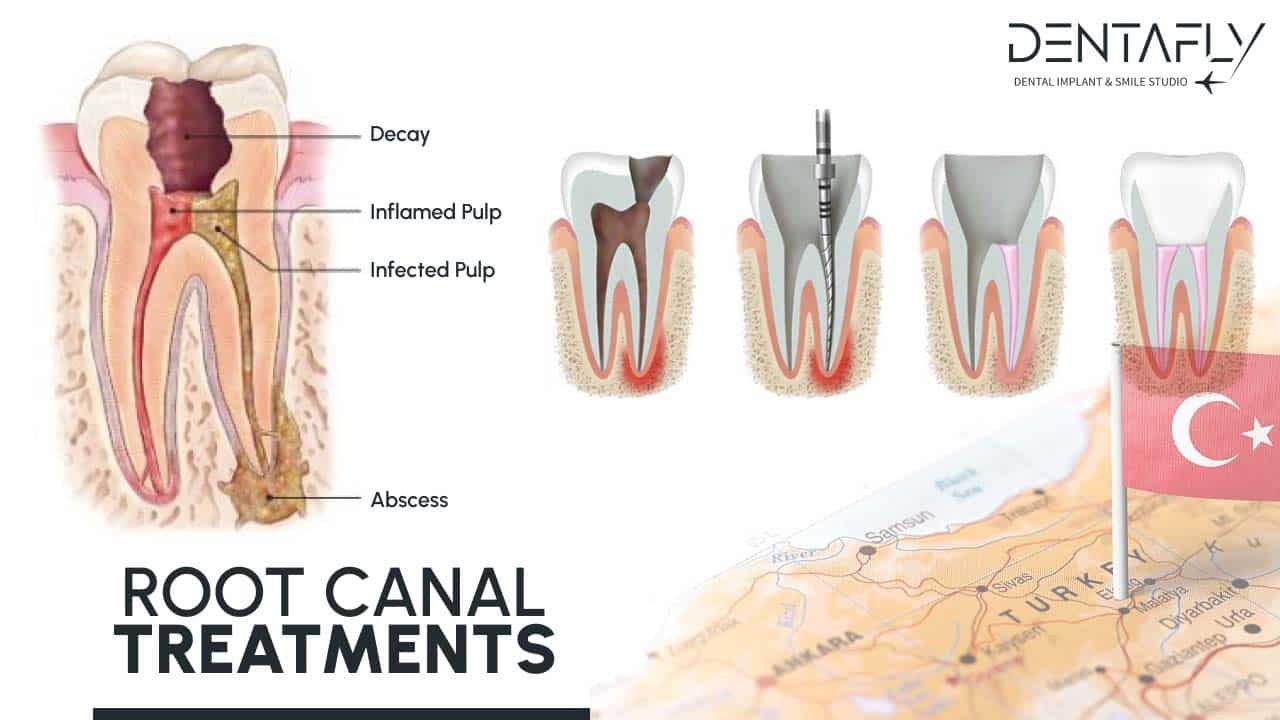 root pulp solution for Gum Treatment