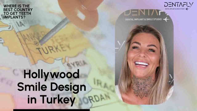hollywood smile design Antalya