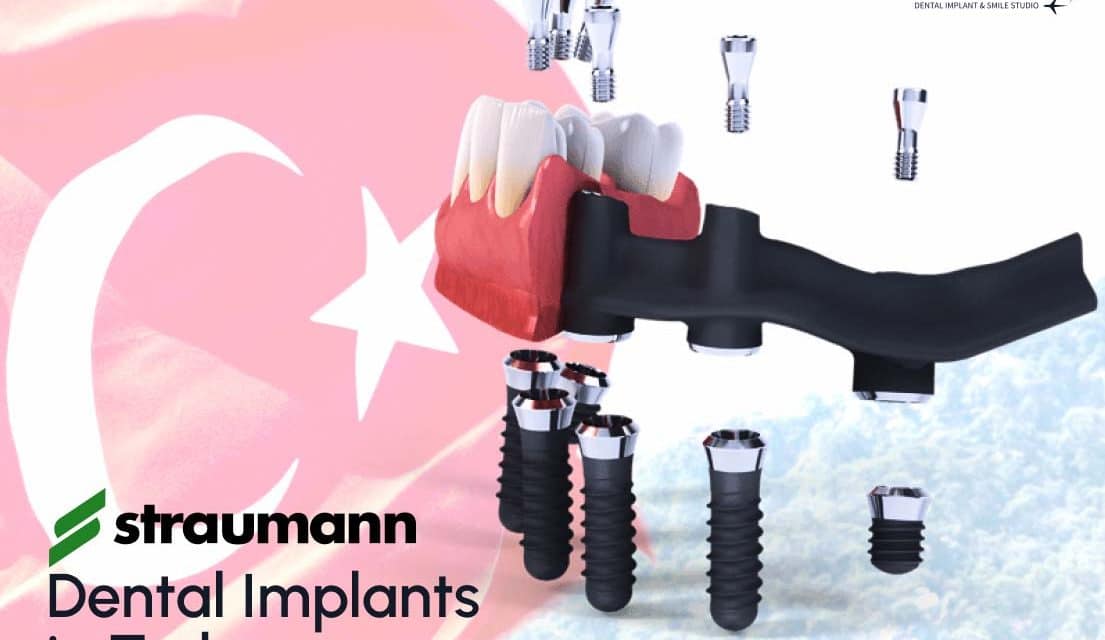 Best Dental Implant Prices in Turkey – 2023 Packages