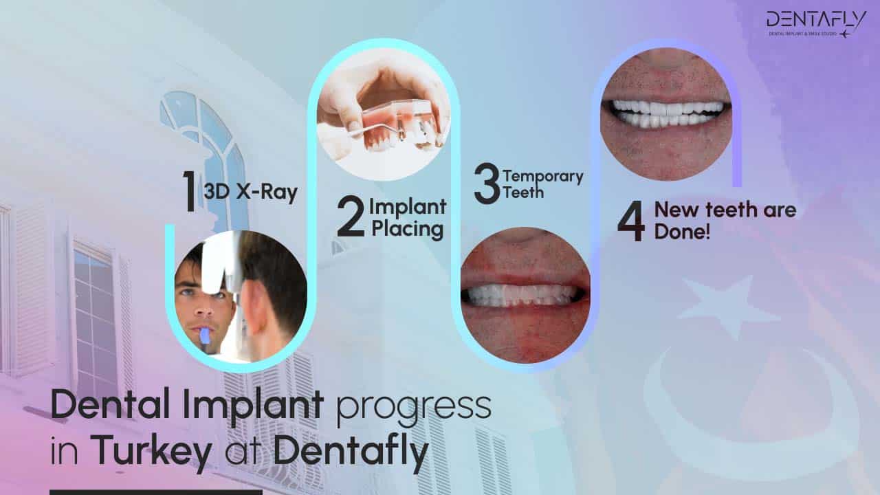Best Dental Implant Prices in Turkey 2023 Packages Denta Fly