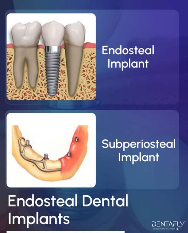 Endosteal dental implants 