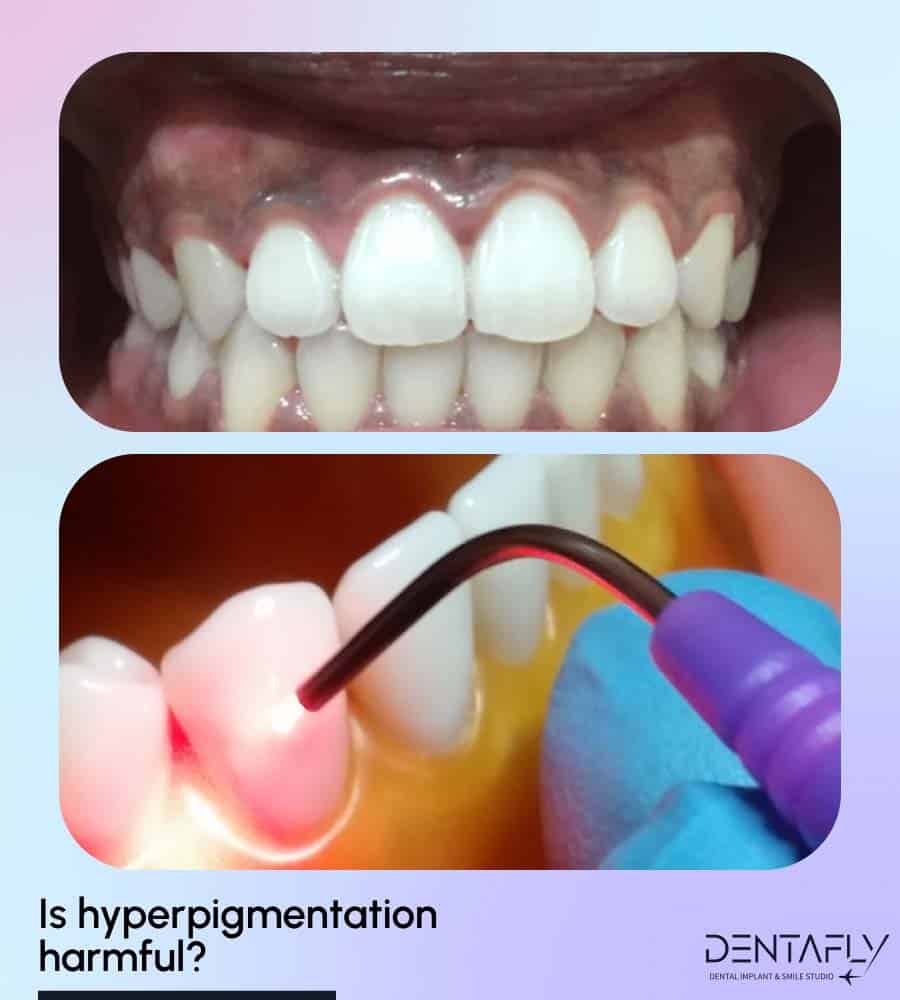 Side effects of Hyperpigmentation