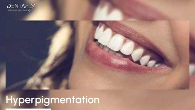 Hyperpigmentation Treatment at Dentafly