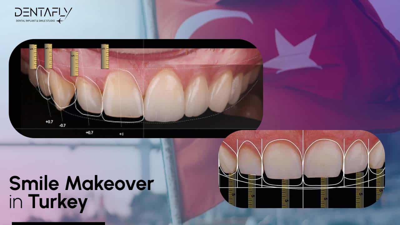 Smile Makeover In Turkey Cost Before After Deals