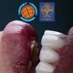 Is It safe to have dental implants in Turkey?