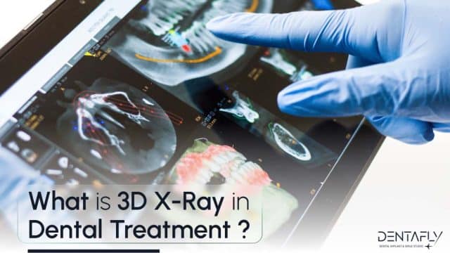 What is 3D X-Ray in Dental treatment?