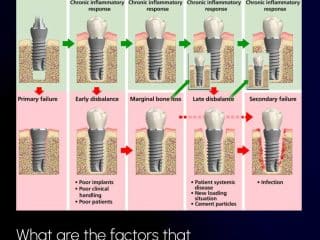 osseointegration success ratio