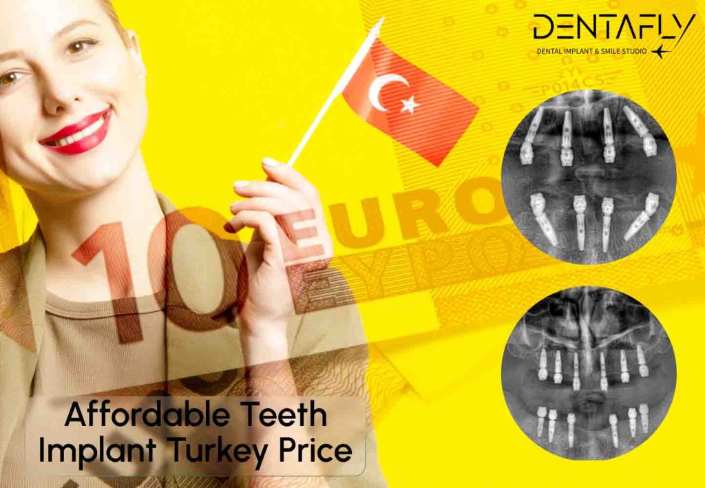 Teeth Implants: All About Costs in Turkey
