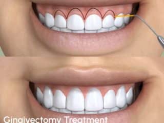 gingivectomy treatment procedure