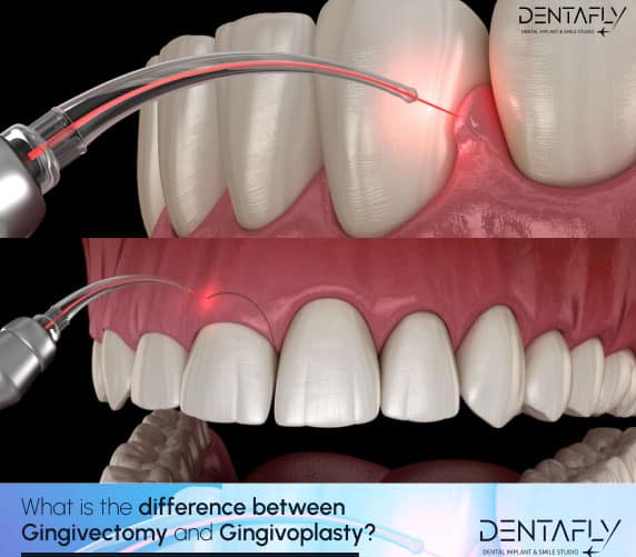 gingivectomy vs gingivoplasty