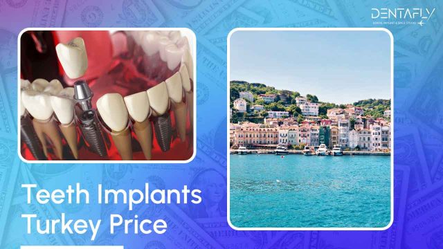 Teeth implants Turkey Price