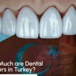 Dental Veneers in Turkey: How Much, FAQs, 2023 Cost