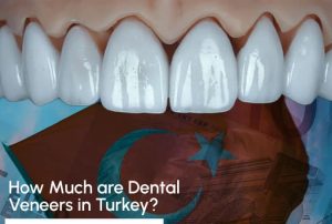 How much are dental veneers in Turkey