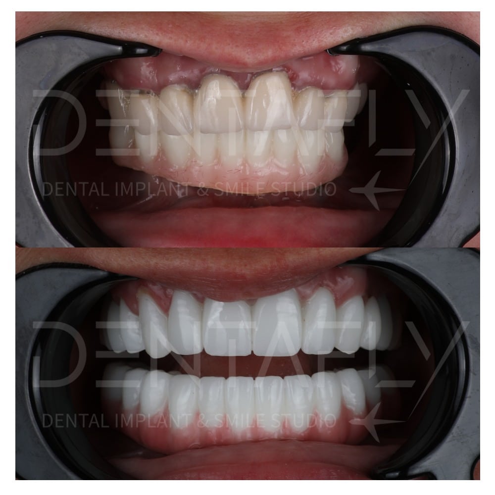 All on Four Before After cases done in Ankara Turkey