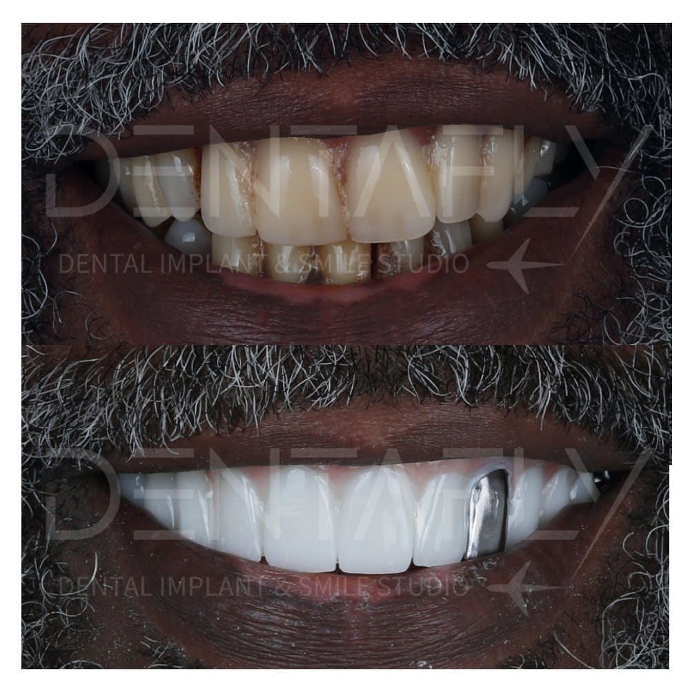All on Four Treatment before after case with single silver tooth