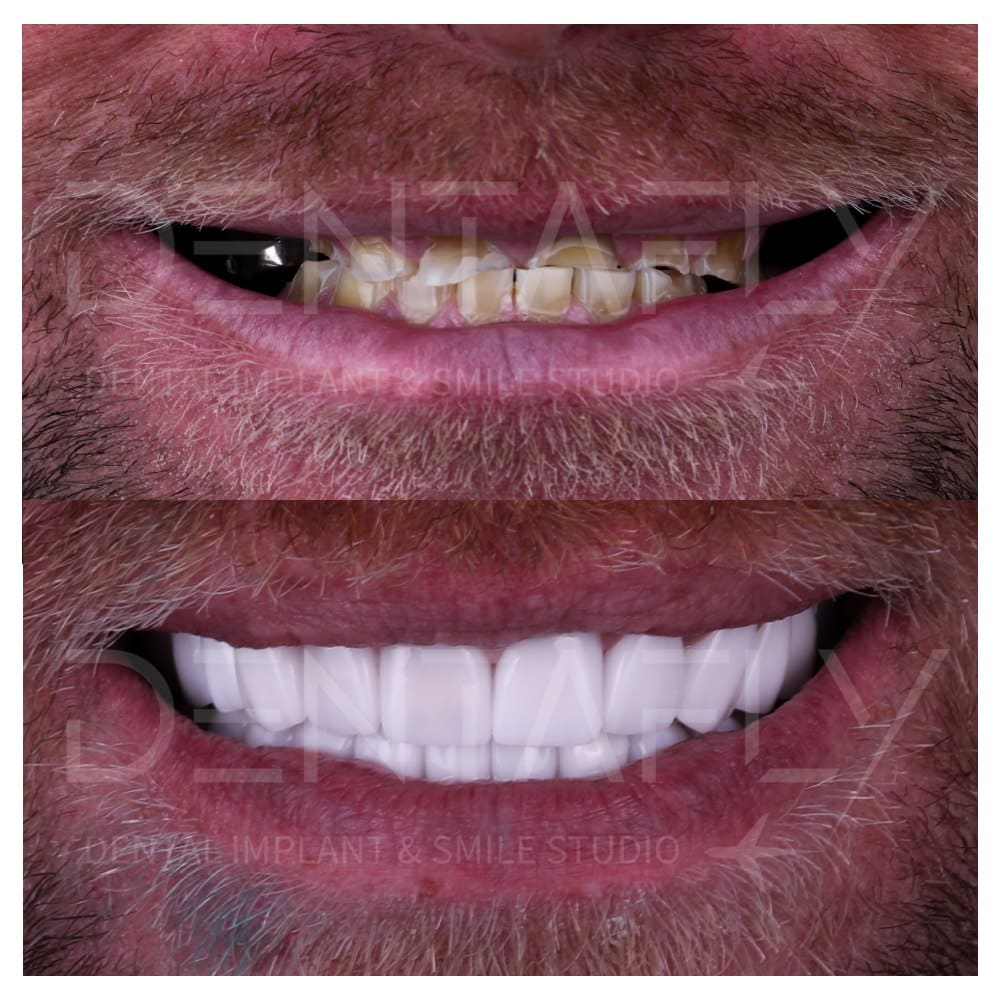 man teeth done by all on four method