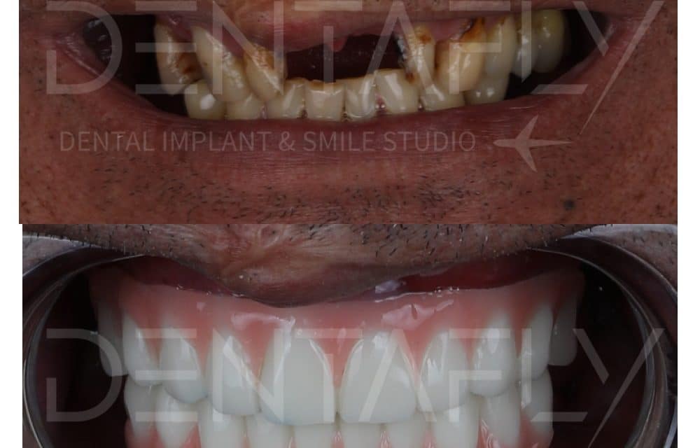 Before After All on Six Photos