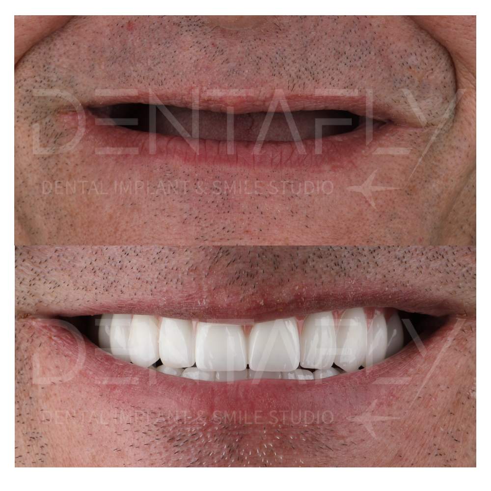 dental implant treatment before after photos