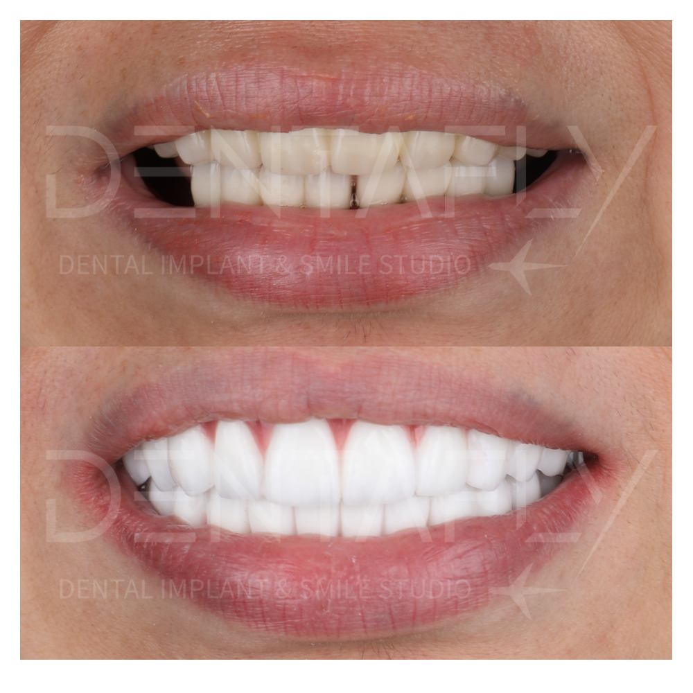 dental implant treatment before after photos