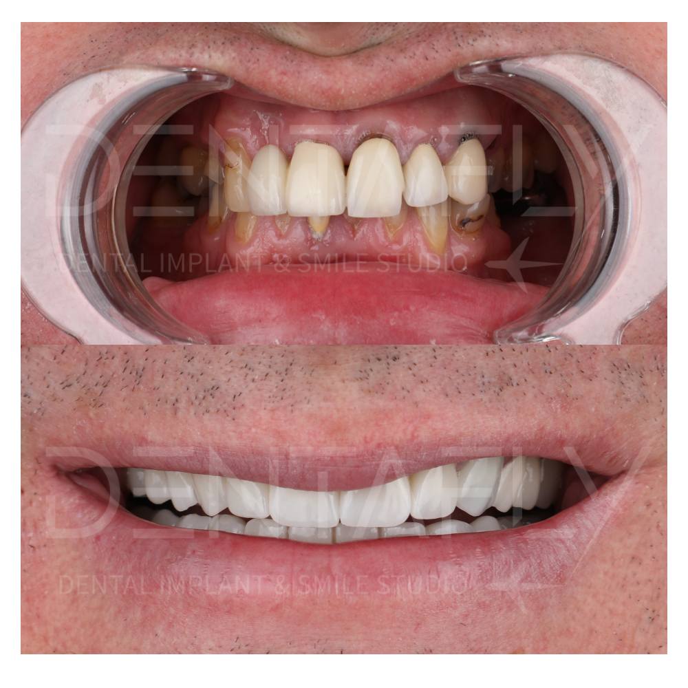 Before After views of Dental Implant Treatment
