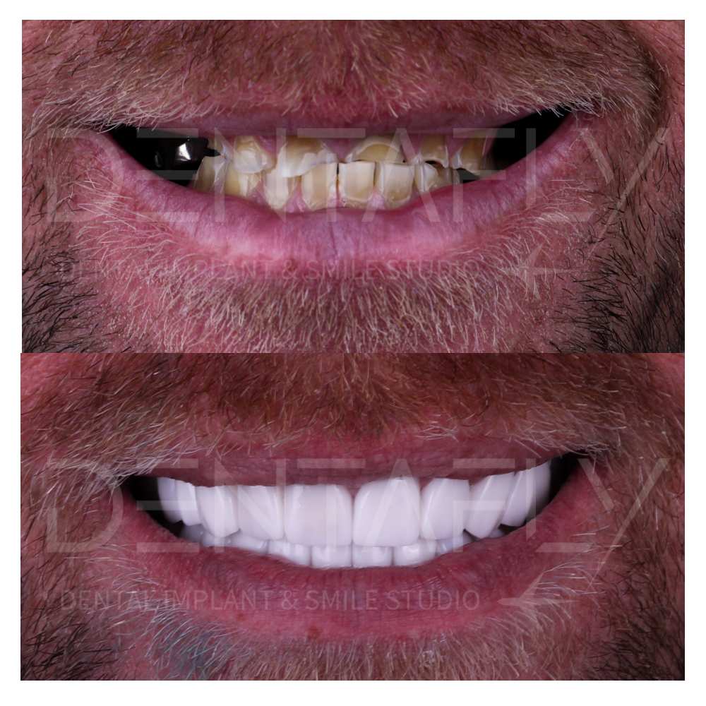 Dental Implant process done in Turkey